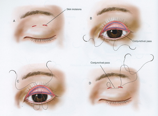 Incision Vs Suture Eyelid Surgery Asian 17
