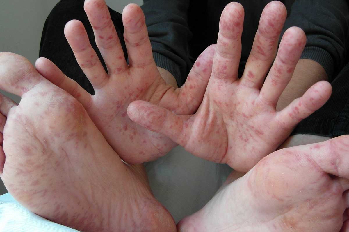 Hand, Foot and Mouth Disease In Children