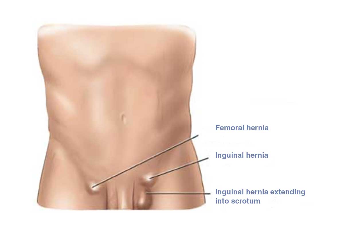 Inguinal Hernias in Children