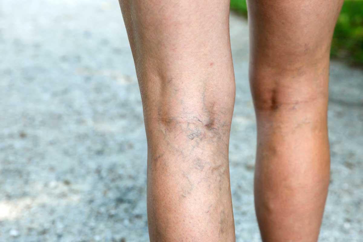 Varicose Veins: What Is It?