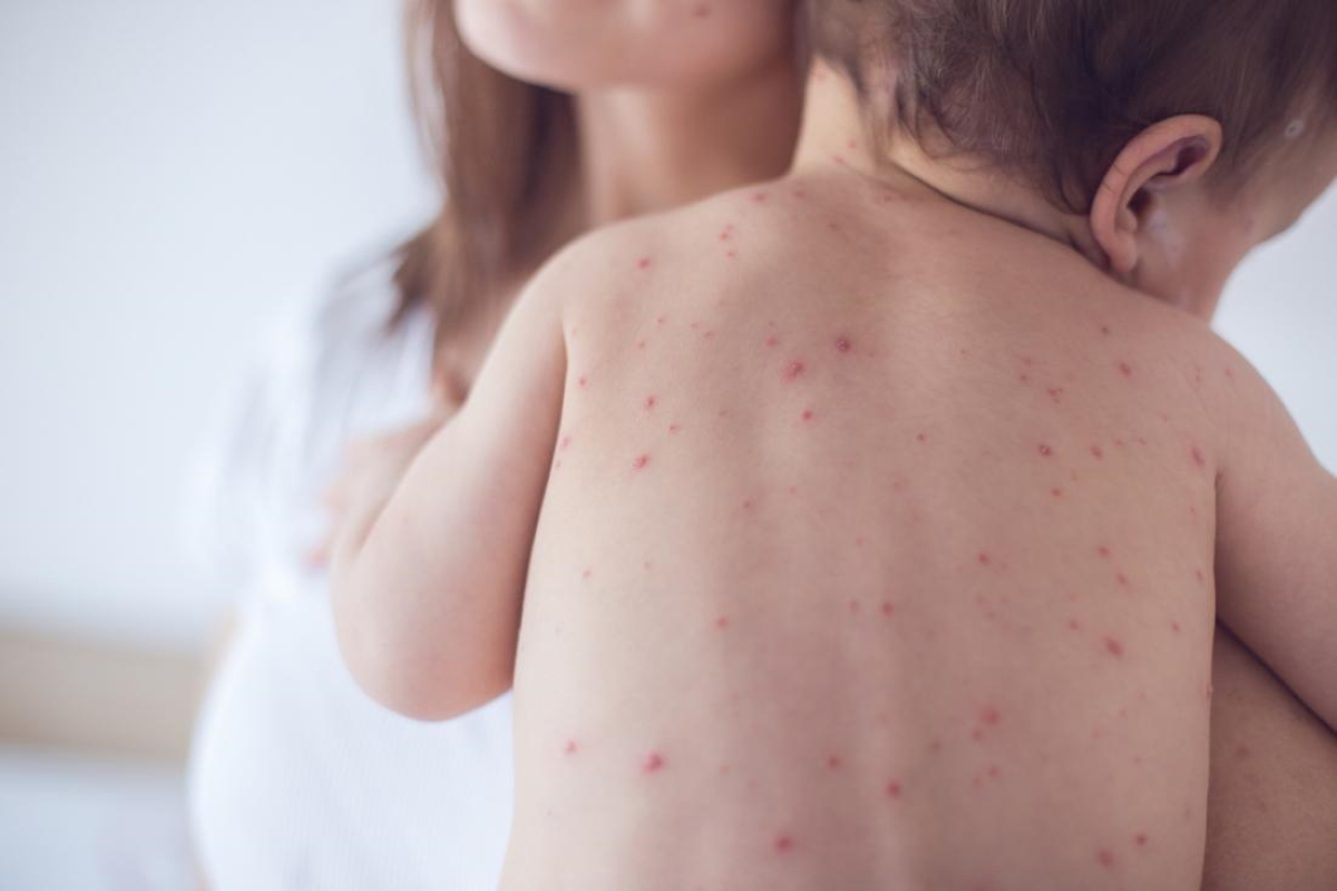 Measles: What Is It?