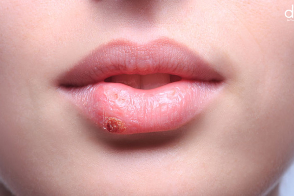Genital Herpes Infection