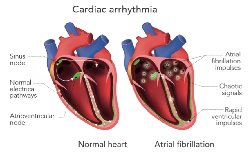 Cardiac Arrhythmia Ablation Treatment - Healthtips by TeleMe