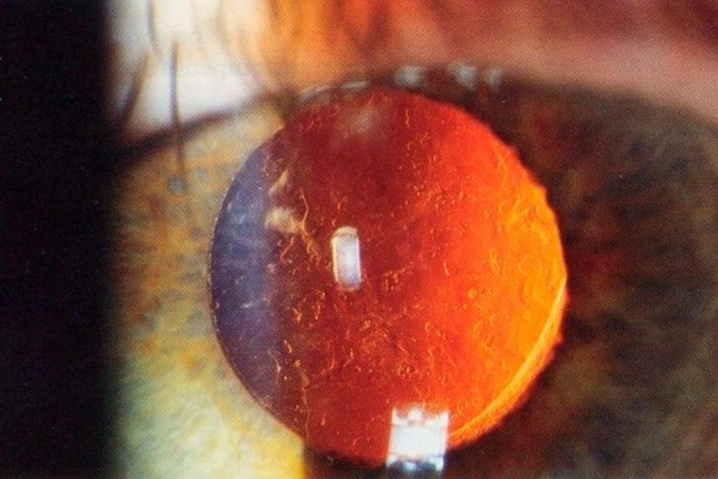 YAG Laser for Posterior Capsule Opacification Healthtips by TeleMe