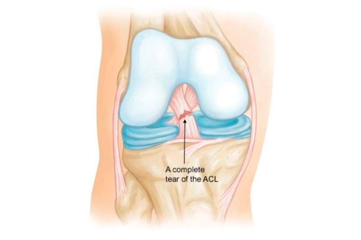 Anterior Cruciate Ligament Knee Surgery