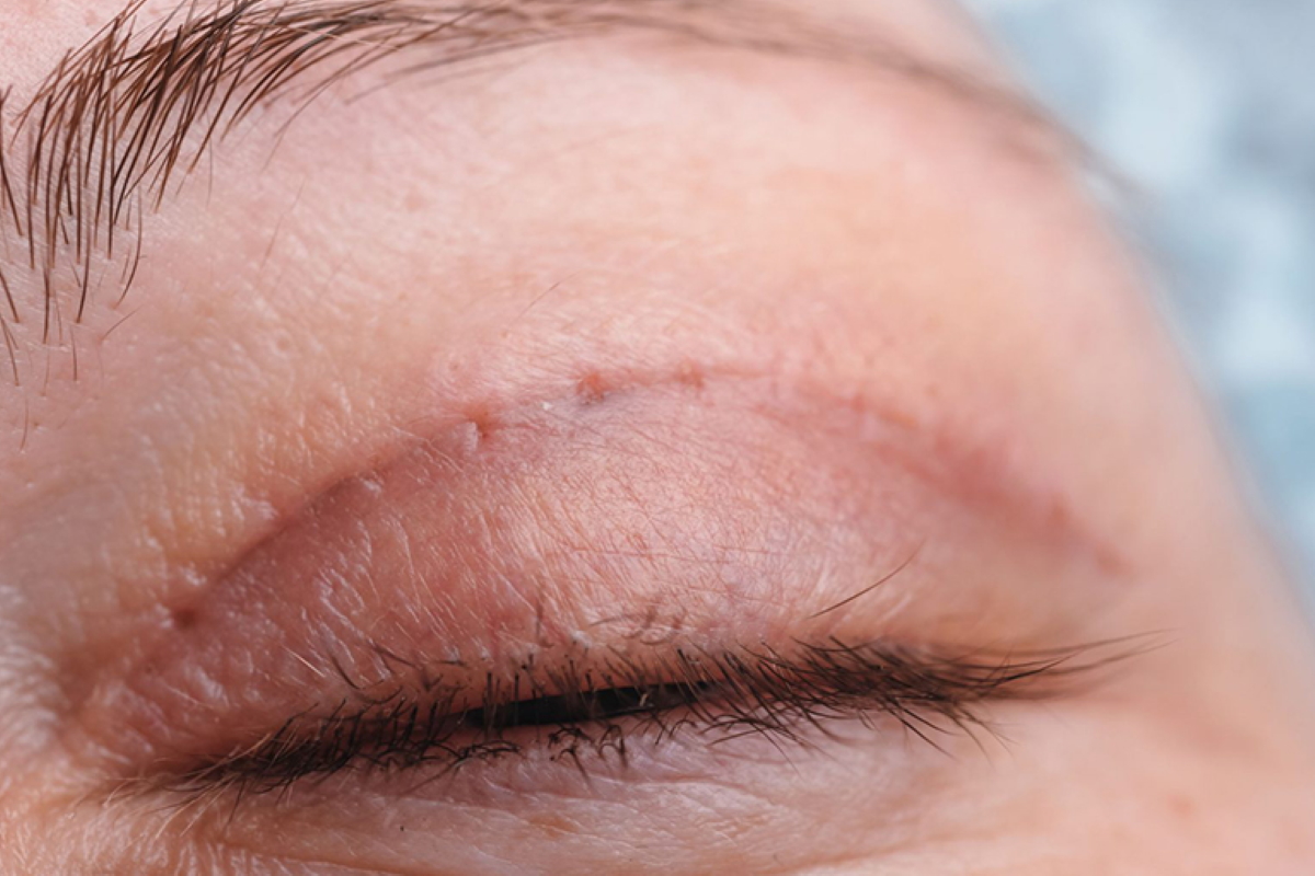 Eyelid Scarring Repair