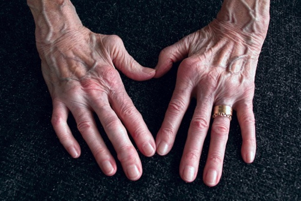 Rheumatoid Arthritis - Pilihan Rawatan