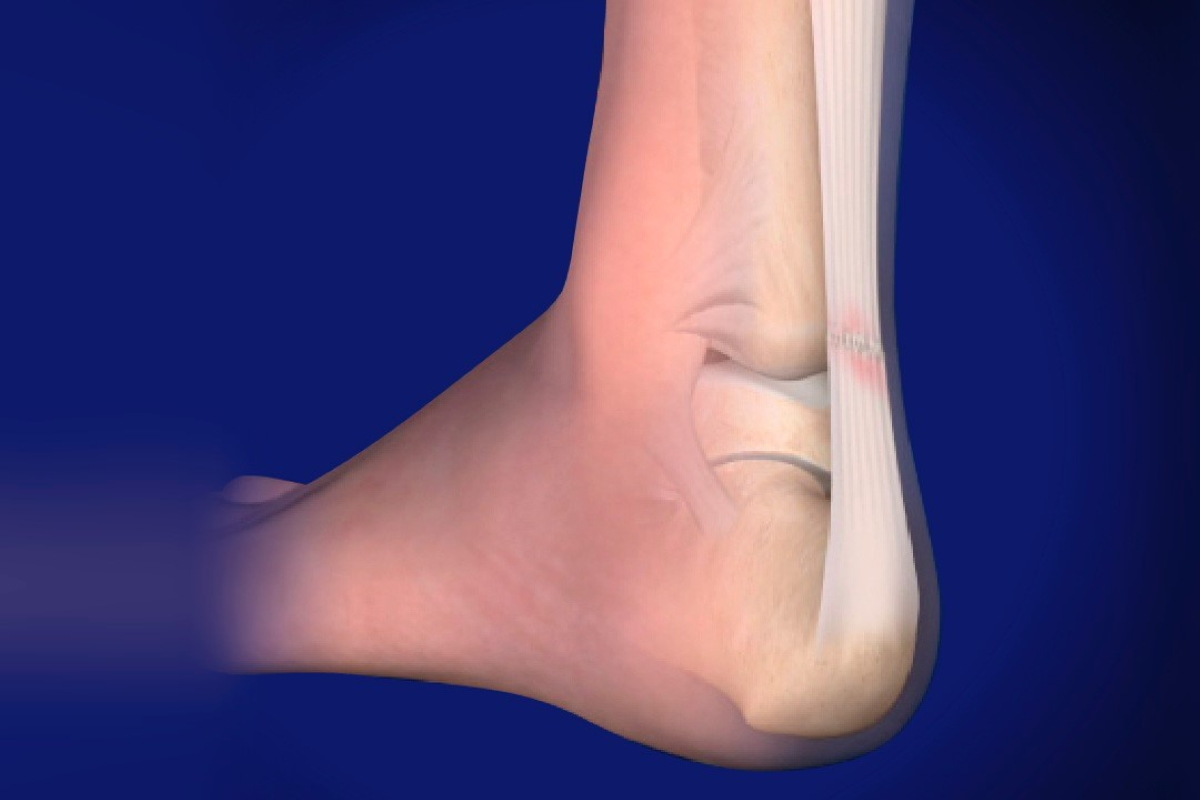 Surgical Treatment for Achilles Tendon Injury