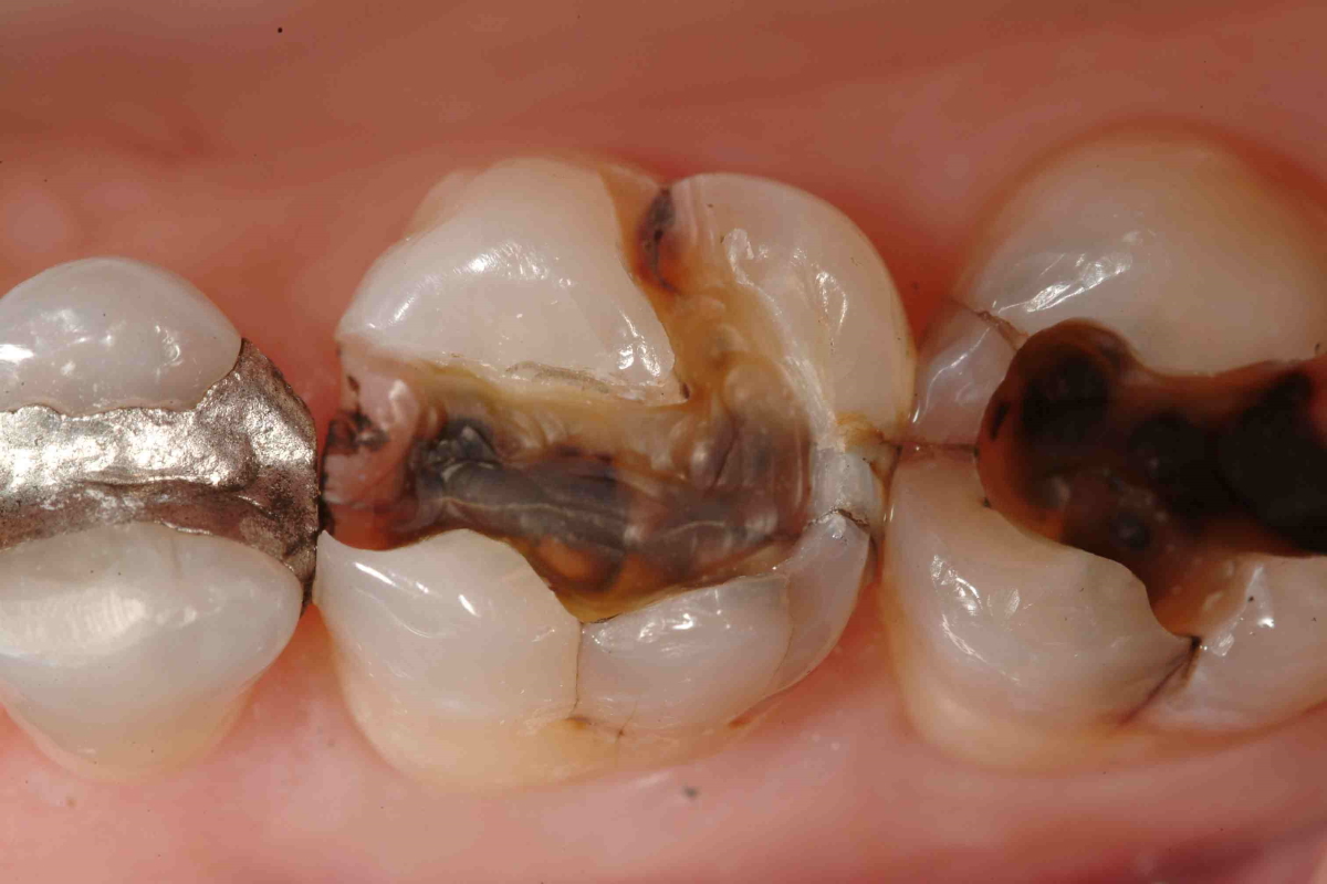 牙齿破裂或有裂痕的治疗