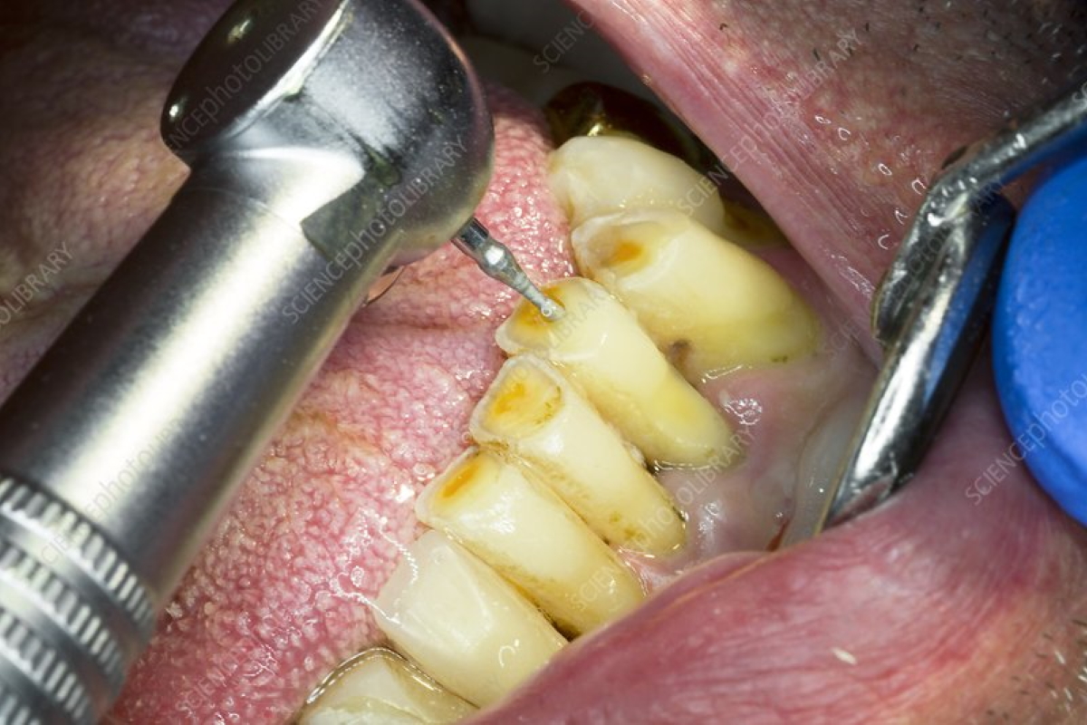 Root Canal Surgery (Apicectomy)
