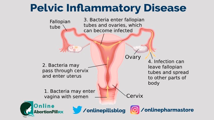 pelvic inflammatory disease bacteria