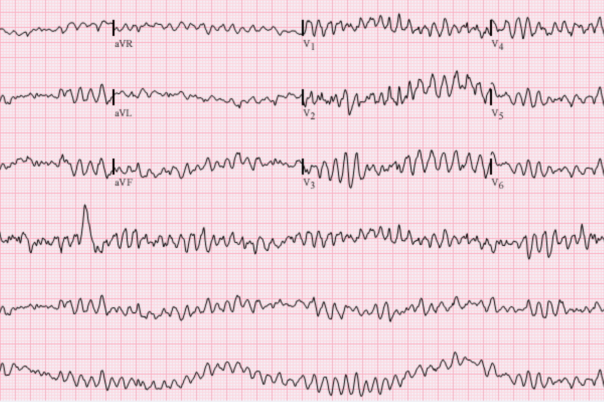 Abnormal Heart Rhythms (Arrhythmias)