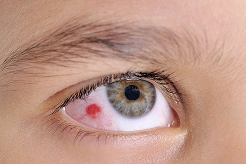 Eye Haemorrhage - Healthtips by TeleMe