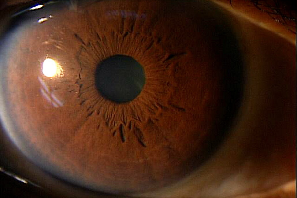 Narrow Angle (also known as Acute Healthtips by TeleMe