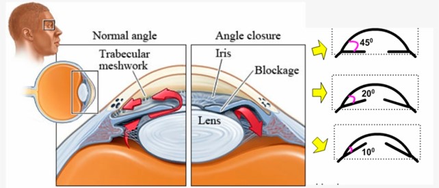 closed angle glaucoma vs open angle