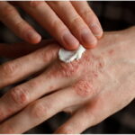 Eczema Prevention & Skin Care