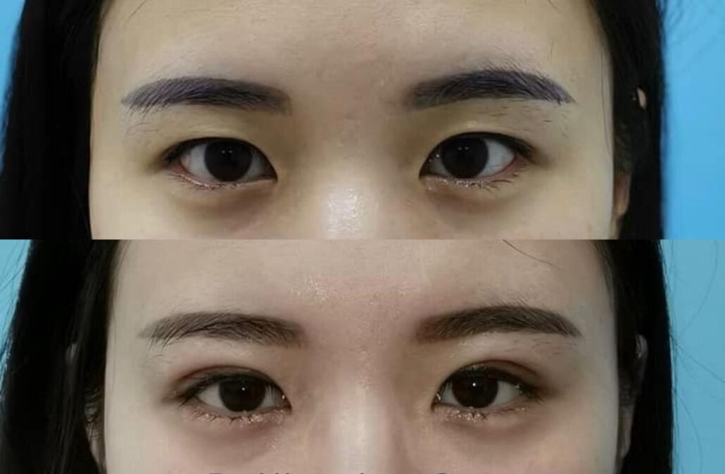 Asian Post Op Telegraph   Asian Blepharoplasty 1030x673 