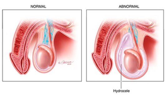 What Causes Groin Swelling In Young Children And What To Do About It In  Malaysia