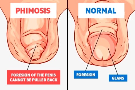 Phimosis Healthtips by TeleMe