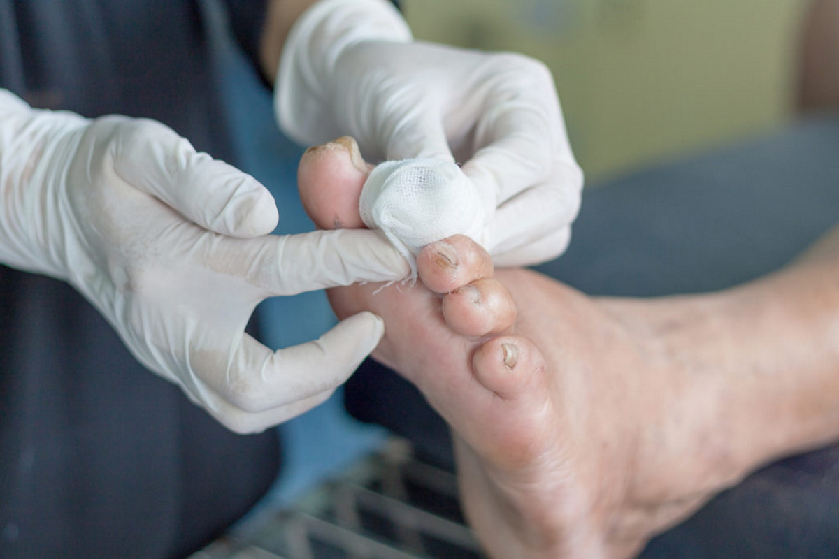 Diabetic foot ulcers: Causes, diagnosis & management