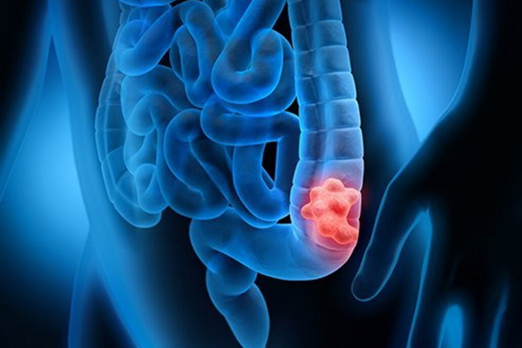 colon-treatment