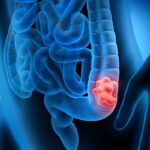 Treatment Options for Colon Cancer