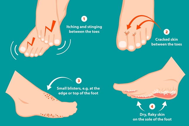 Complications from tinea pedis. Vesicles on the back of a foot