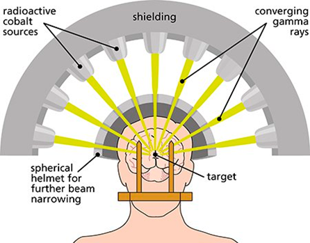 Gamma Knife Surgery Healthtips By TeleMe Gamma Knife Surgery Healthtips By TeleMe