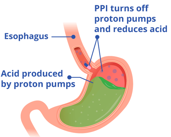 Proton pump inhibitors for Gastric symptoms - Healthtips by TeleMe