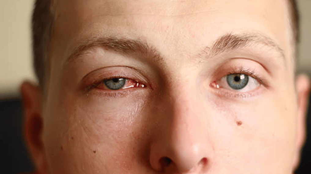 Allergic Conjunctivitis Eye Allergy Healthtips By Teleme
