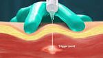 Trigger Point Injections